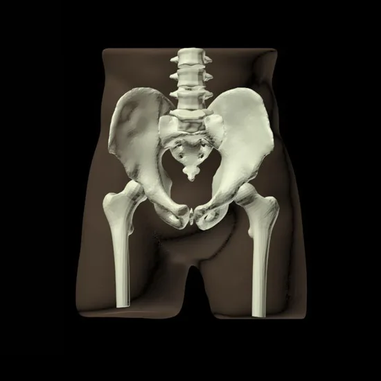 3D CT Scan Pelvis